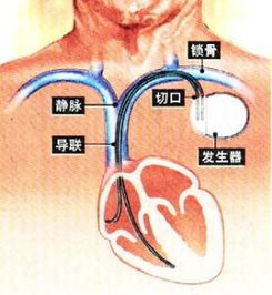 最小心脏起搏器问世，为生命注入新动力