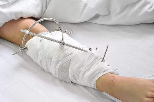 女子意外摔倒骨折获赔七万